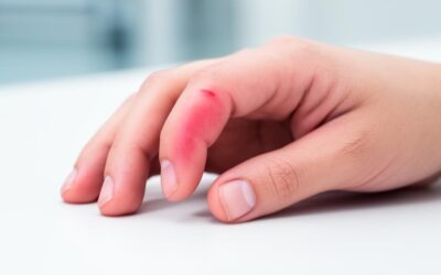 How to Tell if the Fingertip is Broken and Prevent Potential Complications from Developing
